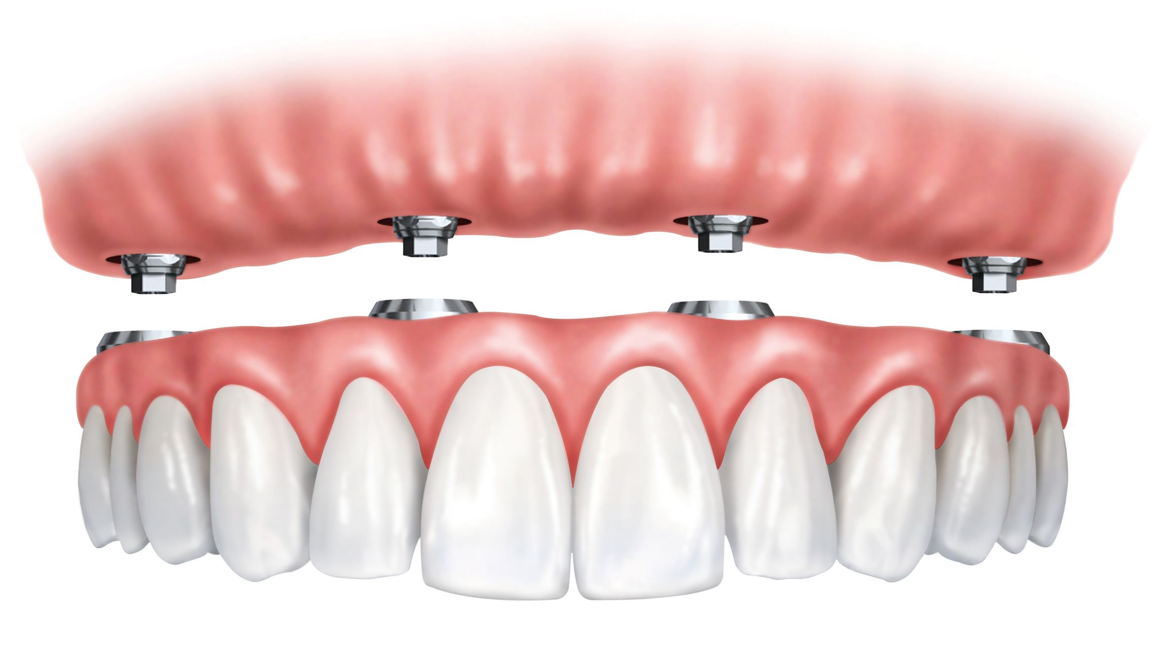 A graphic demonstrating how implant-supported dentures are fitted onto a patient