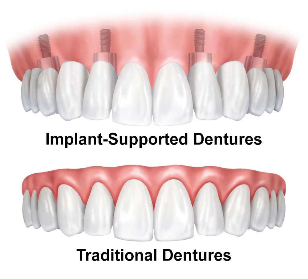A graphic demonstrating the difference between traditional and implant-supported dentures.