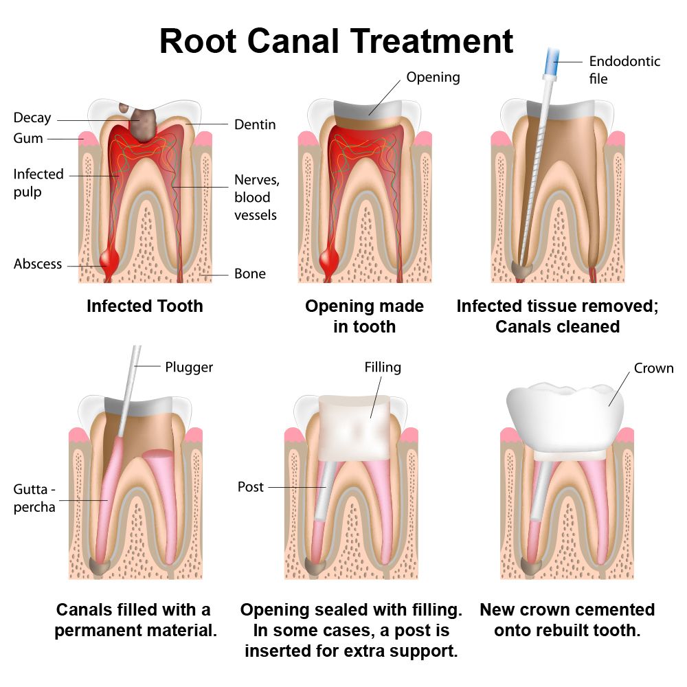 A graphic displaying the different stages of a root canal.
