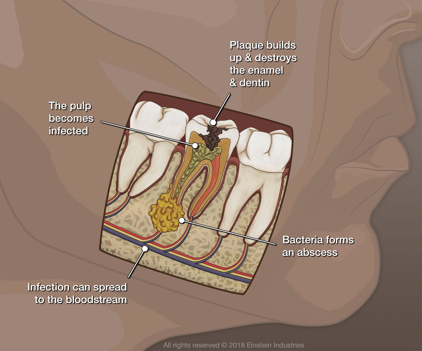 Illustration of dental infection