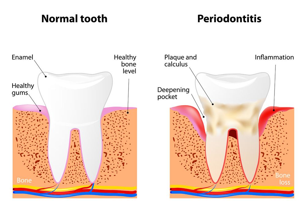 A graphic comparing a healthy tooth with one affected by periodontal disease.